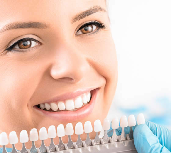 Facettes dentaires : quels bénéfices sur la confiance en soi ?