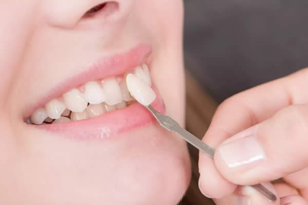 Facettes dentaires : peut-on les enlever ?