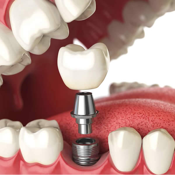 Implants dentaires : ce que votre dentiste veut que vous sachiez