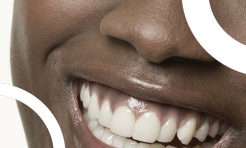 Quels Sont Les Types de Facettes Dentaires? - Clinique Ekiz