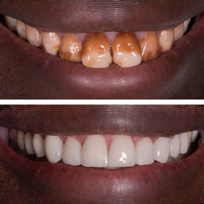 Blanchiment des dents: comment se fait la procédure, sa durée et  contre-indications - The Care Trip