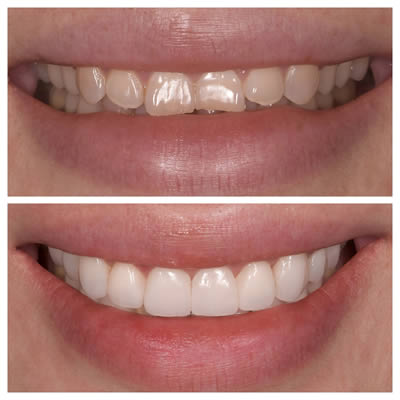 résultats pose de facettes dentaires elone clinic