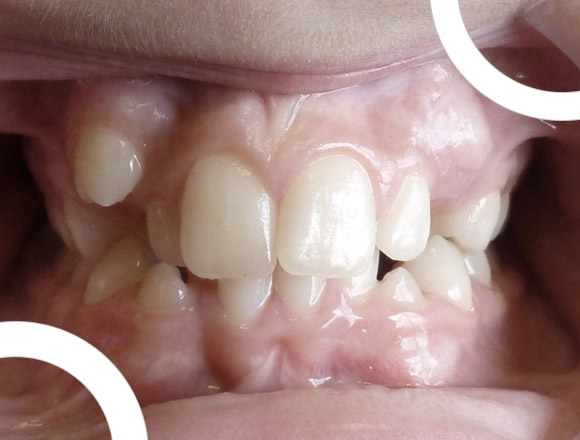 FAQ  En quoi l'orthodontie adulte diffère-t-elle de l'orthodontie pour  enfant ?