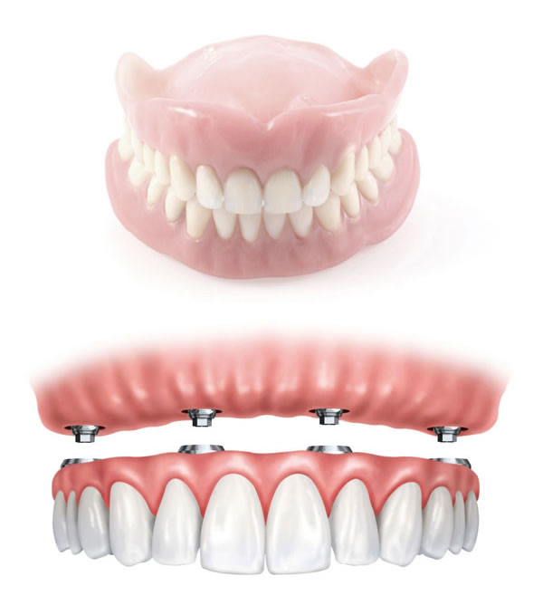 Prothèses dentaires: les différents types de prothèses fixes et amovibles